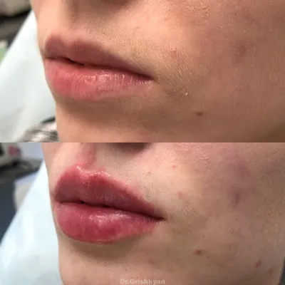 Алкоголь до и после увеличения губ - Cosmetic-clinic