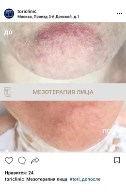 Мезотерапия лица без уколов, цены в Москве