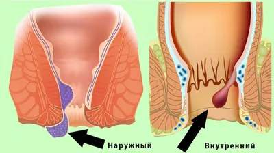 Причины возникновения геморроя, способы лечения гемороя