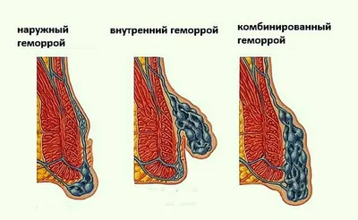 Геморрой - симптомы, лечение, причины и профилактика геморроя - Гармония