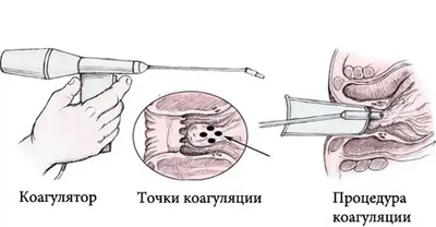 Геморрой: причины, виды, методы лечения и последствия для здоровья