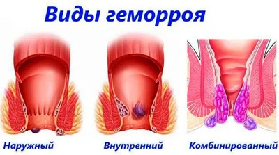 Геморрой - что это, симптомы заболевания, диагностика и лечение