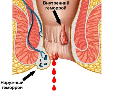 Геморрой лечение геморроя у мужчин и женщин в Москве цена в Клинике ABC