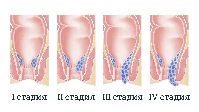 Геморрой у мужчин и женщин - суть проблемы, причины, симптомы, стадии,  лечение | Mednavigator.ru | Дзен