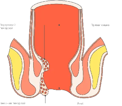 Лечение Геморроя