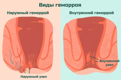 Берут ли в армию с геморроем? (Чаще всего берут)