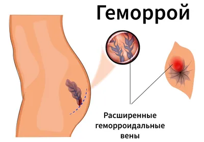 Геморрой: симптомы, причины, наружный и внутренний, стоимость лечения и  операции