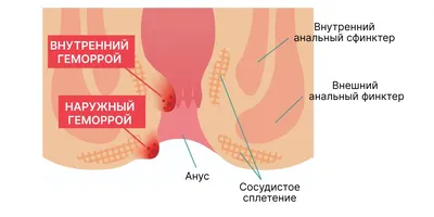 Свечи от геморроя эффективные и недорогие для мужчин и женщин