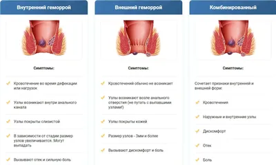 Геморрой – причины, симптомы, диагностика и способы лечения заболевания |  Клиника Будь Здоров