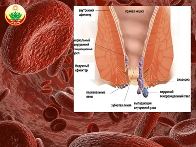 Геморрой: что такое? Как бороться? - статьи от компании Еламед