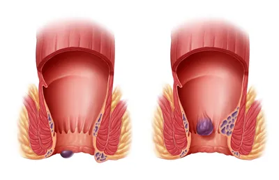 Наружный геморрой - причины развития, классификация, симптомы, диагностика,  лечение и профилактика