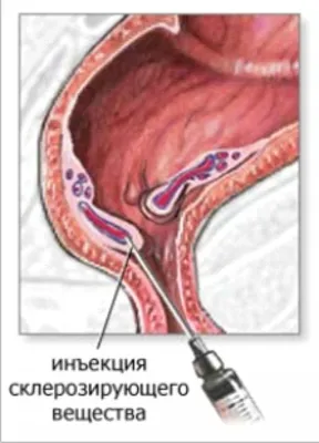 Клиника \"Медлайн\" - Лечение геморроя на каждой стадии. ⚕ ⠀ 1️⃣ При первой  стадии предпочтение отдают медикаментозному лечению или инфракрасной  фотокоагуляции. ⠀ 2️⃣ При второй стадии медикаментозное лечение ещё  допустимо, но альтернативной