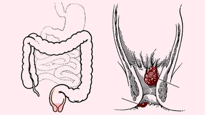 Геморрой: причины, симптомы, стадии, виды, осложнения, профилактика