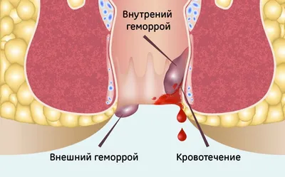 Новый вариант хирургического лечения хронического комбинированного геморроя  III-IV стадии