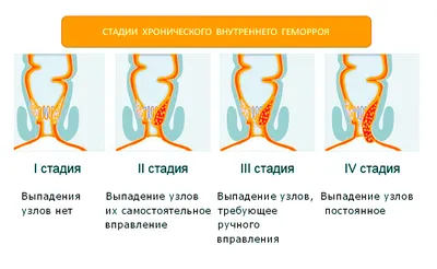 Лечение геморроя | клиника \"Скандинавия\"