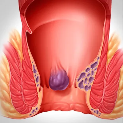 Эффективное Лечение геморроя без операции в Симферополе