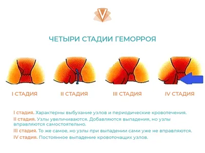 Эффективное лечение внутреннего геморроя - блог Виртус