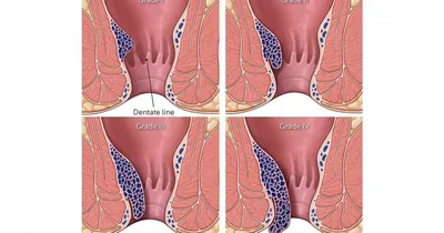 Геморрой: симптомы, причины, наружный и внутренний, стоимость лечения и  операции