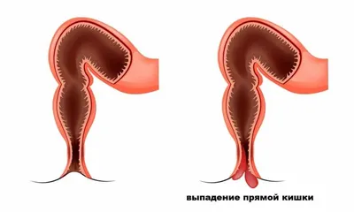 Лечение геморроя с тромбозом в медицинском центре «Я здоров», цены в  Новосибирске