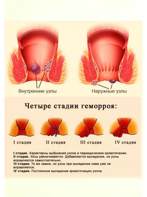 9 методов лечения геморроя у женщин и мужчин: рейтинг, отзывы, советы врачей