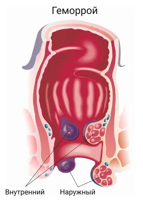 Клиника Medimax - Медимакс - Геморрой Что такое геморрой? Симптомы геморроя  Виды геморроя Стадии геморроя Причины геморроя Осложнения геморроя Методы  лечения геморроя Профилактика геморроя Что такое геморрой? Геморрой — это  заболевание аноректальной