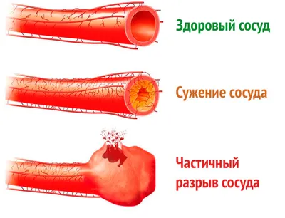 Лечение хронического внутреннего геморроя 2 степени в медицинском центре «Я  здоров», цены в Новосибирске