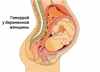 Способы лечения геморроя на разных стадиях — блог медицинского центра ОН  Клиник