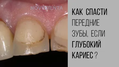 Как лечится кариес передних зубов? - YouTube