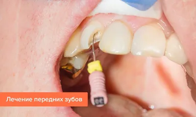 Кариес на передних зубах — что делать, как лечат, стадии, фото кариеса на  передних верхних и нижних зубах
