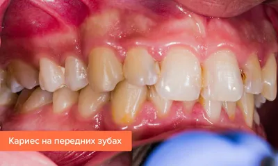 Кариес на передних зубах — что делать, как лечат, стадии, фото кариеса на  передних верхних и нижних зубах