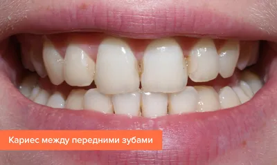 Кариес между зубами — что делать и как лечить
