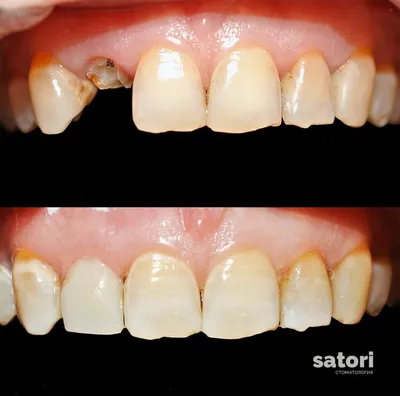 Лечение зубов в Самаре: кариес и его осложнения - Клиника Сатори