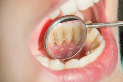 Лечение передних зубов в СПб: цена от 3 500 ₽ в стоматологии OrthoLove