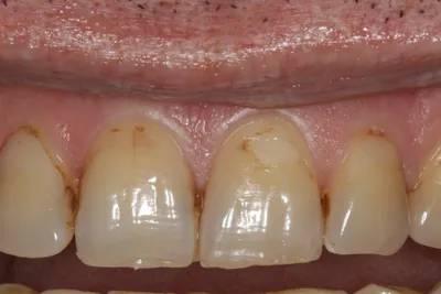 Реставрация передних зубов: выполненная работа с фото до и после в  стоматологии OneDent