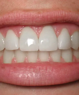 Лечение кариеса передних зубов цена в Москве: симптомы и виды лечения в  стоматологии Smile Guru