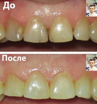 Фотополимерные пломбы в передних зубах :: Лечение зубов в г. Харьков