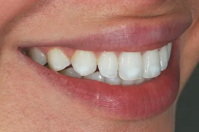 Лечение кариеса - цена в 32Dent :: Лечение глубокого и поверхностного кариеса  зубов