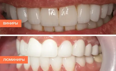 Лечение передних зубов – как лечат фронтальные зубы, методы, фото до и  после и отзывы