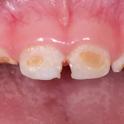 Suukool.ee - Laste hammaste tervis - Заболевания зубов и дёсен