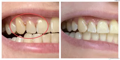 Эстетическая стоматология - художественная реставрация зубов - «Существенно  улучшить ВНЕШНИЙ ВИД зубов по ЦЕНЕ обычного лечения → Вы думаете это  невозможно? Я тоже так думала» | отзывы