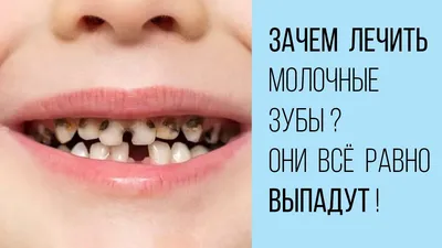 Лечение кариеса молочных зубов у детей: цена, фото, методы лечения
