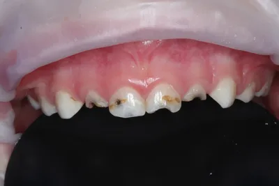 Реставрация передних зубов: прямая, непрямая