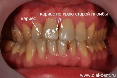 Лечение кариеса на передних зубах