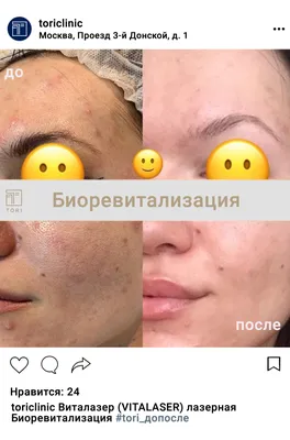 Лазерная биоревитализация Vitalaser кожи лица, губ и шеи, цены в Москве