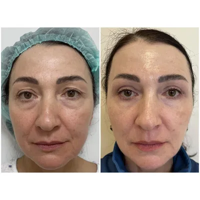 Липофилинг лица, фото до и после, цены в Москве в клинике Dr.Vasilenko