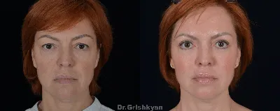 Липофилинга лица фото до и после | Клиника Доктора Гришкяна