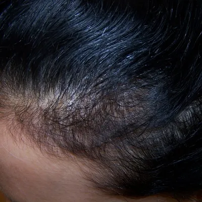 Мезотерапия волосистой части головы в Москве, отзывы, цены, фото до и после,  видео