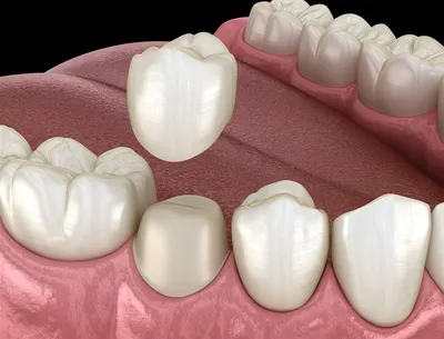Современные коронки: восстановление и надежная защита зубов