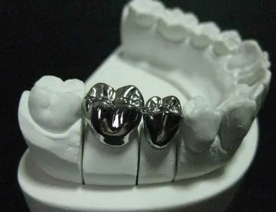 Металлические коронки на зубы | Стоматология Ас-Стом | Санкт-Петербург (СПб)