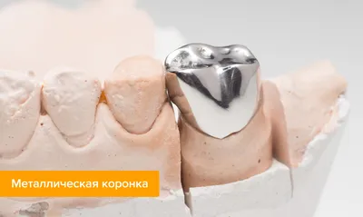 Как ставят коронку на зуб — этапы, фото до и после установки зубных коронок  на Startsmile.ru